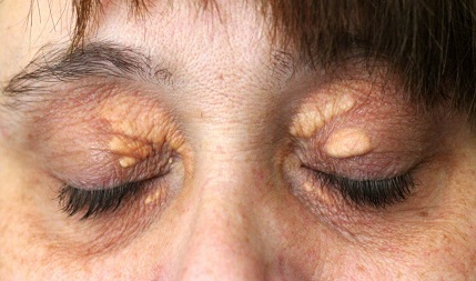 upper corner eyelid bump        
        <figure class=